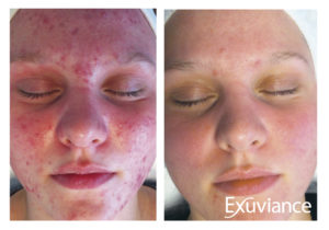 Ennen ja jälkeen Exuviance-aknehoidon