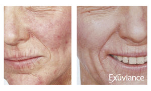 Atooppinen ekseema ennen ja jälkeen Exuviance-hoidon