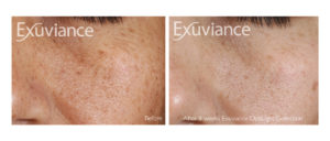 Hyperpigmentaatin eli maksaläiskien hoitaminen Exuviance tuotteilla