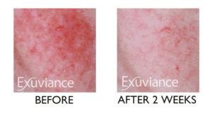 Exuviance hoito tekee ihmeitä. Ennen ja jälkeen kuva todistaa, kuinka ruusufinnistä pääse eroon helposti.