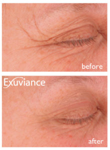 Ennen ja jälkeen Exuviance-hoidon. Näe, kuinka ihme tapahtuu.